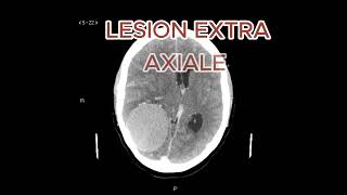 INTRA VS EXTRA AXIALE radiologystudent hospitalityeducation femmemedecine [upl. by Katheryn973]