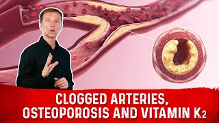 Clogged Arteries Osteoporosis and Vitamin K2 – Dr Berg [upl. by Cressler]