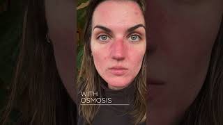 Osmosis Results  Blemish Prone Skin [upl. by Iluj167]