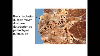 ANAPATH PNEUMO Pathologies dystrophiques et inflammatoires pulmonaires [upl. by Nwahshar]