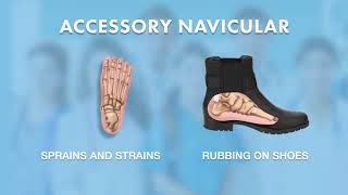 What is Accessory Navicular  Ask Dr Silverman [upl. by Manson]