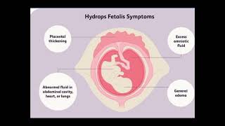 HYDROPS FETALIS ULTRASOUND FEATURES [upl. by Azmah576]