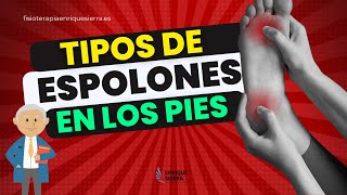 TIPOS DE ESPOLONES EN LOS PIES O EL TALÓN 👣 [upl. by Ronyar]