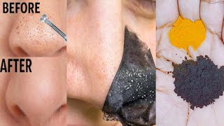 Blackheads and whiteheads removal cream  How to remove blackheads and whiteheads permanently [upl. by Sheila]