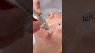 mesotherapy face mesotherapy mesoface facemeso [upl. by Atiz]