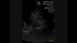 Vscan FAST positif Echographie et urgences [upl. by Abelard]