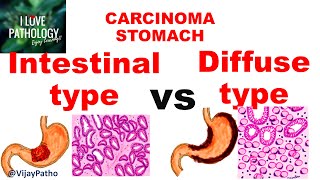 Carcinoma Stomach INTESTINAL VS DIFFUSE GASTRIC CANCER [upl. by Mas393]