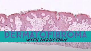 Dermatofibroma with induction phenomenon pathology dermpath dermatology dermatopathology [upl. by Anom]