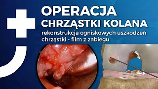 Operacja chrząstki kolana  film z zabiegu  Nowa Ortopedia [upl. by Ricarda673]