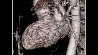 Cardiac perfectly timed cardiac CT angiographic study with normal anatomy 1 of 16 [upl. by Matthia]