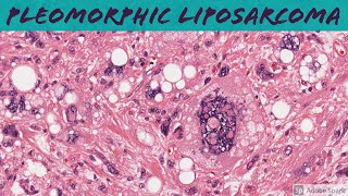 Pleomorphic Liposarcoma 5Minute Pathology Pearls [upl. by Inanak948]