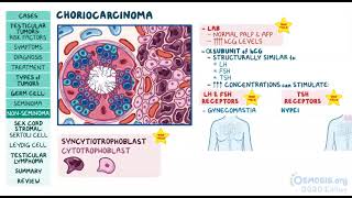 Testicular Tumors  Osmosis [upl. by Argella]