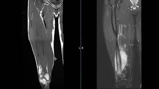 Thigh pain in young athlete [upl. by Fulbert]