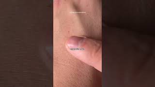 Annoying little bumps on skin 😩 ⁠shorts skincare acnetips [upl. by Ferri159]