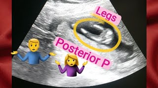 13 weeks oregnant gender reveal  posterior placenta means baby boygirl  how to tell gender on usg [upl. by Icyak]