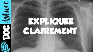 🔴 Dr Astuce  3 ANOMALIES RADIO THORAX EXPLIQUÉES CLAIREMENT  PARTIE 1 [upl. by Hgielrac71]