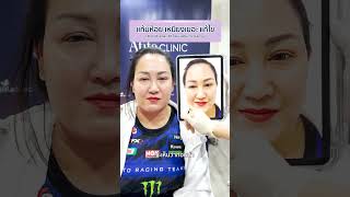 HIFU 7D  รีวิวการทำ HIFU Tel0943244442 Line  atitaclinic [upl. by Adnawed]