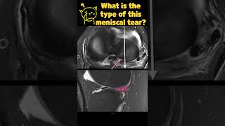 Fig 1B04 LongitudinalVertical Meniscal Tears with ACL tear [upl. by Ardiedal]