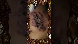 Blackheads Removal  Acne Treatment and Very Satisfying Satisfying Pimple pop blackheads [upl. by Iiette]