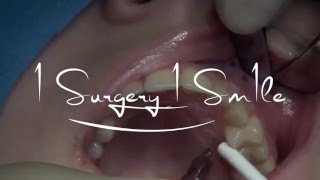 Impacted canine extraction and immediate placement 1 Surgery 1 Sm1le By Dr Bechara [upl. by Anael480]