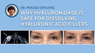 How Hyaluronidase Injections to Remove Filler is Done Safely [upl. by Htiek]