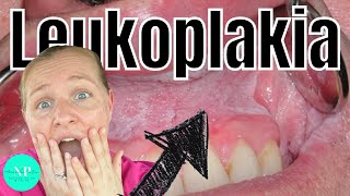 Leukoplakia  Causes Diagnosis amp Treatment WHAT CAUSES LEUKOPLAKIA [upl. by Licastro]