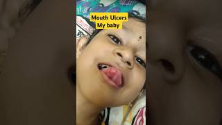 ulcers mouth ulcer shorts shortvideo [upl. by Sartin]