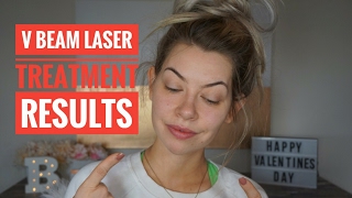 V Beam Laser Treatment Results  Part 2 [upl. by Humfried]