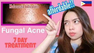 FUNGAL ACNE 1 WEEK TREATMENT  tiny little bumps MALASSEZIA FOLLICULITIS [upl. by Rape305]