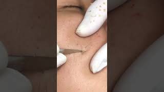 Best Pimple Popping 13 reels beautiful blackheads sacdepspa cute health [upl. by Bonny901]