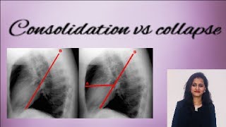 Chest X ray  How to differentiate consolidation from collapse [upl. by Eillil604]