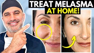 What you NEED to know about treating Melasma AT HOME the RIGHT way [upl. by Ahsinyar]