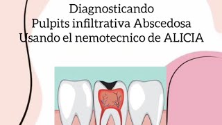 Diagnóstico de pulpitis usando el memo técnico ALICIA [upl. by Ned]