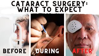 What To Expect Before During And After Cataract Surgery [upl. by Cadmann]