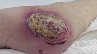 Wound Care Part 3 Types of Wounds [upl. by Atiuqcaj]