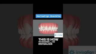 invisalign overbite [upl. by Ahseia]