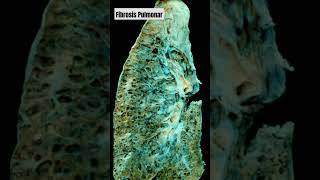 Fibrosis pulmonar medicina [upl. by Leiva]