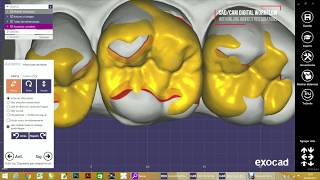 Flujo de trabajo digital para incrustaciones dentales [upl. by Eirot]