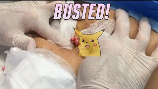 Epidermoid Cyst on Shoulder Excised  Busted at 230 [upl. by Yaffit549]