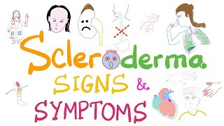 Scleroderma Pathogenesis and Clinical Manifestations Detailed Explanation [upl. by Ereveniug]