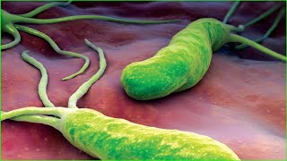 🔴 H pylori Infection Symptoms Causes Diagnosis and Treatment 🦠 Risk factors include📰 [upl. by Ahsrav630]