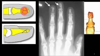 tuft fracture  fracture of the distal finger tip [upl. by Wycoff]