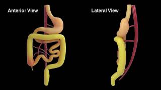 New Revelations in the Pathophysiology and Surgical Management of Congenital Gut Malrotation [upl. by Hamo]