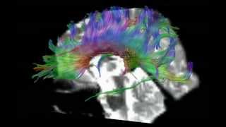 DTI Tractography of Corpus Callosum [upl. by Arahas]