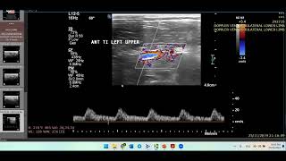 Thromboangitis ObliteransHow to ThinkDoppler Ultrasound Case [upl. by Perlman]