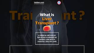 Liver Transplant in India trending trendingshorts explore healthcareindia medicaltourism [upl. by Llehcal]