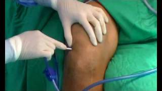 Septic arthritis of the knee arthroscopic debridement [upl. by Nella]