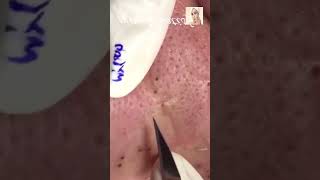 Blackheads Removal  Acne Treatment and Very Satisfying Satisfying Pimple pop blackheads [upl. by Gnas]