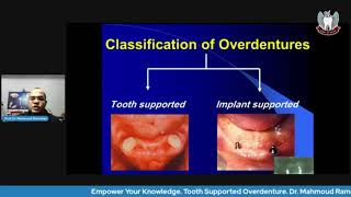 Tooth Supported Overdenture Part 2 Classification Abutment preparation amp Attachments [upl. by Aloibaf319]