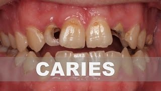 ☞ Secretos caseros para la caries dental – Como combatir la caries en casa [upl. by Liatris]